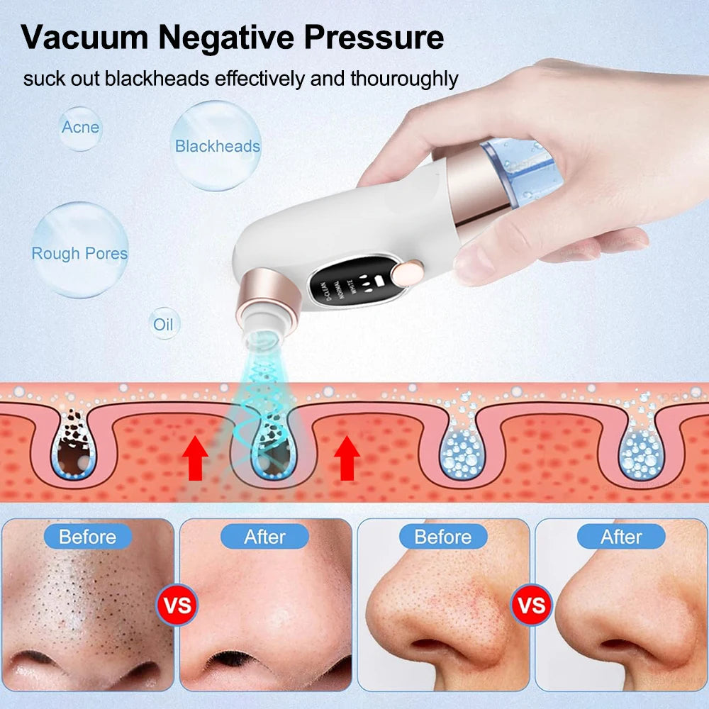 Blackhead Remover Vacuum – Deep Pore Facial Cleanser