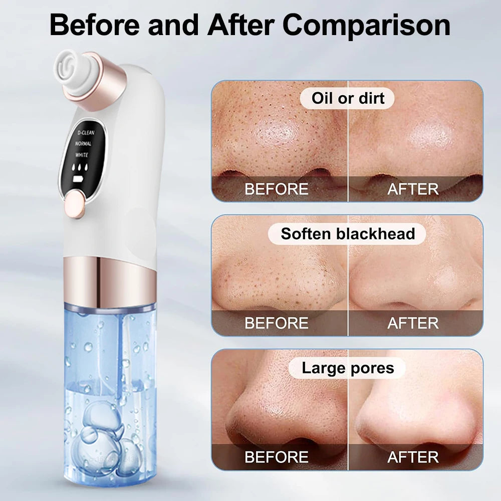 Blackhead Remover Vacuum – Deep Pore Facial Cleanser